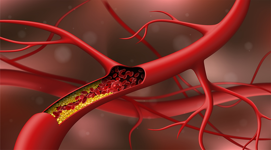 Artery Blocked By Cholesterol. Red Blood Cells In An Artery Bloc