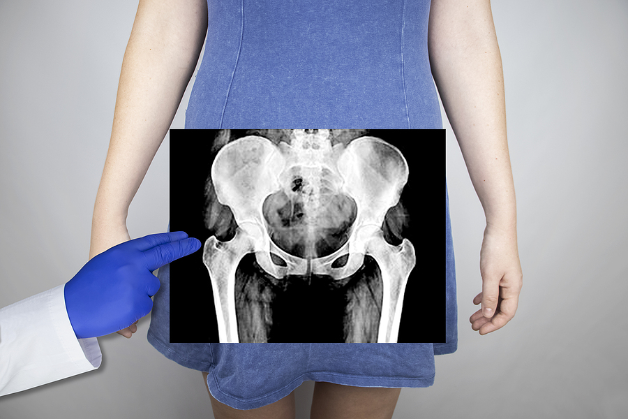 X Ray Of The Pelvic Bones Of A Woman. Radiologist Examines X Ray
