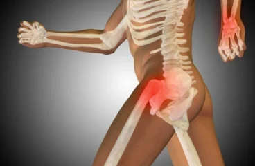 Glut Tendinopathy